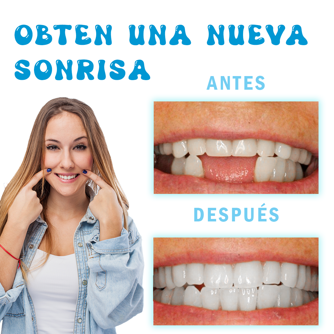 Nueva resina moldeadora: Recupera tu sonrisa sin gastar fortunas en el dentista