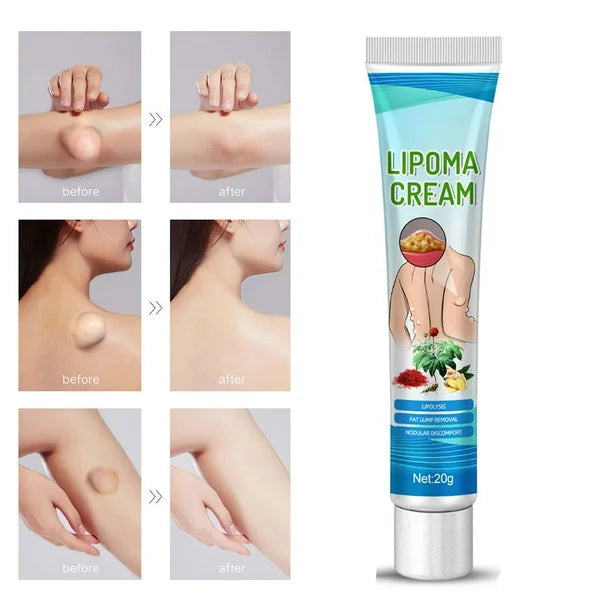 ¡Basta de Bultos! Elimina Lipomas, Fibromas y Protuberancias Grasas sin Cirugía Dolorosa en Semanas