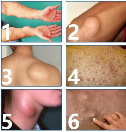 ¡Basta de Bultos! Elimina Lipomas, Fibromas y Protuberancias Grasas sin Cirugía Dolorosa en Semanas