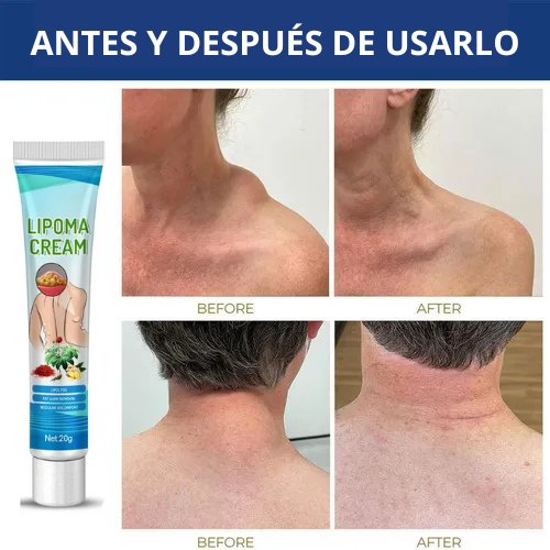 ¡Basta de Bultos! Elimina Lipomas, Fibromas y Protuberancias Grasas sin Cirugía Dolorosa en Semanas