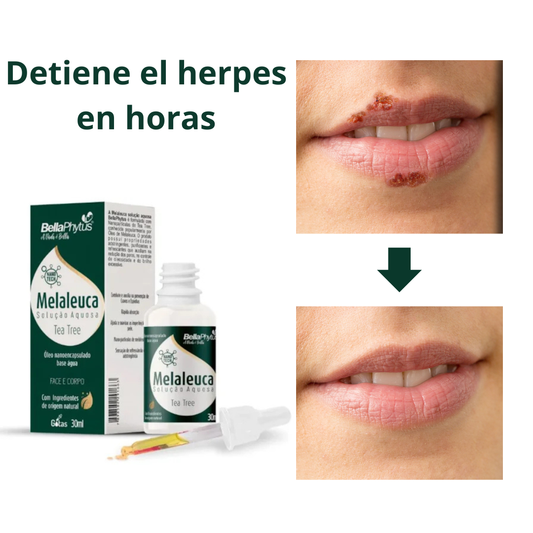 ¡Basta de Vergüenza! Elimina Herpes, Hongos e Infecciones Rápidamente y Protege tu Piel de Recaídas
