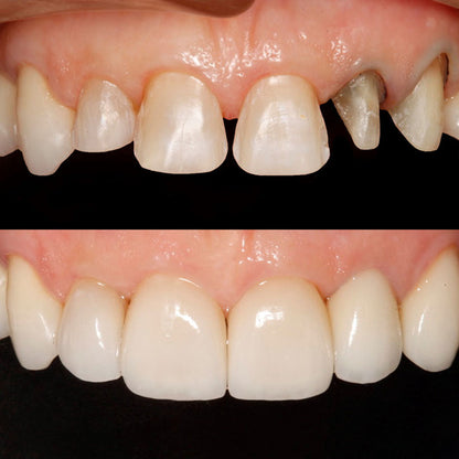 ¡Basta de Ocultarte! Obtén una Sonrisa Perfecta al Instante y Recupera tu Confianza sin Dolor ni Costos