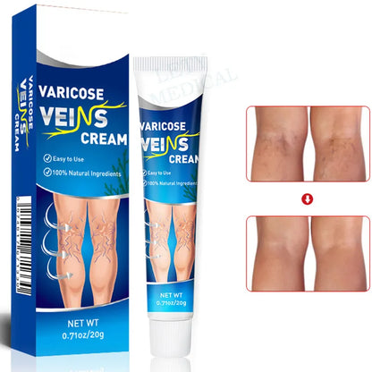 Crema Varicell: Despídete de las Arañitas y la Vergüenza, y Olvídate del Dolor ¡Piernas Perfectas en Pocas Semanas!